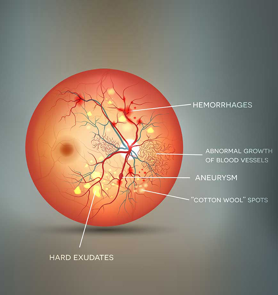 Diabetic Eye Disease
