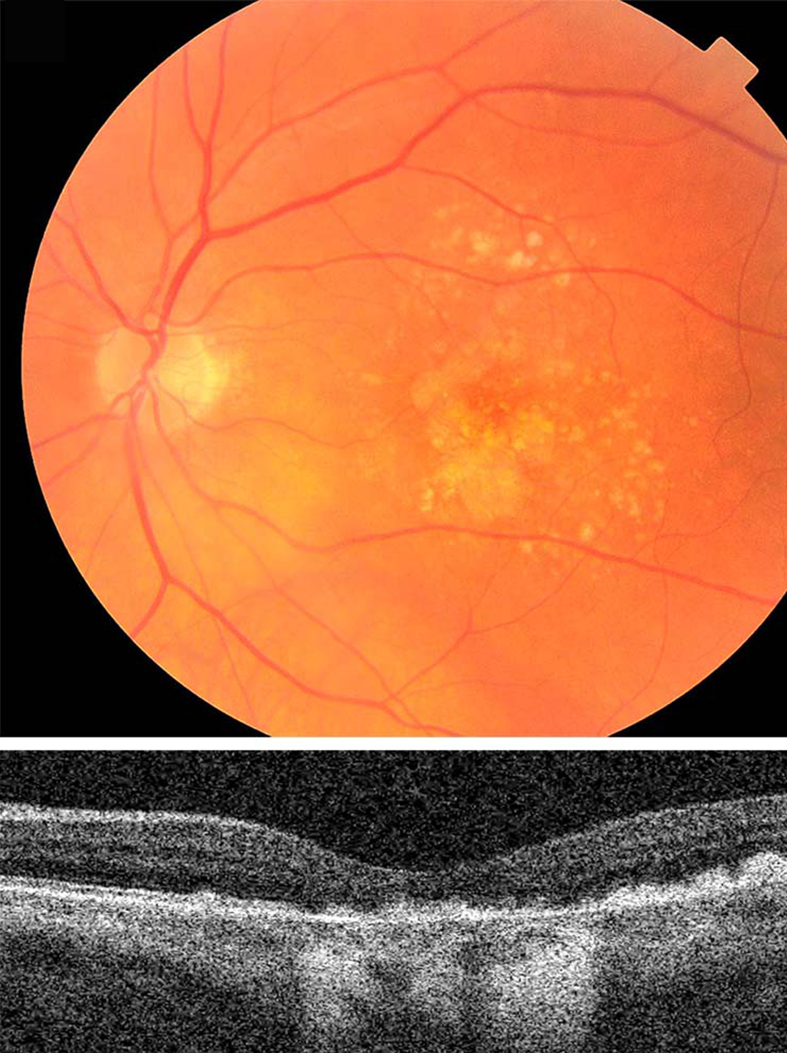 Macular-Degeneration