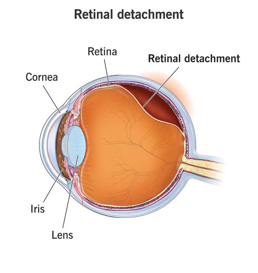 Retinal Detachment